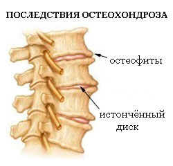 Tratamentul coloanei vertebrale lombare sacral