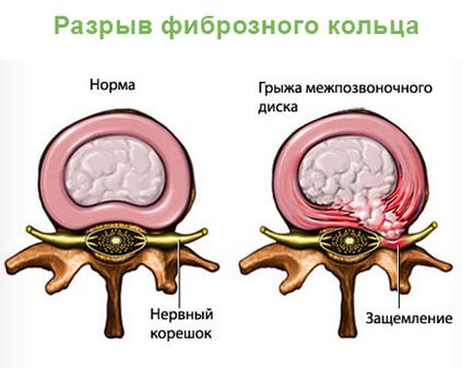 Tratamentul coloanei vertebrale lombare sacral