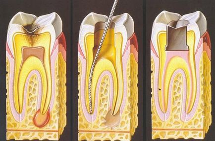 Care este tratamentul pulpitei
