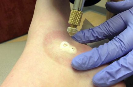 Birthmark sângerează care fac Birthmark sângerează care fac
