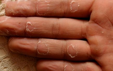 Decorticate și pielea oblazit pe degete, cauzele si tratamentul