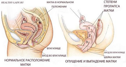 Ce cade uterul