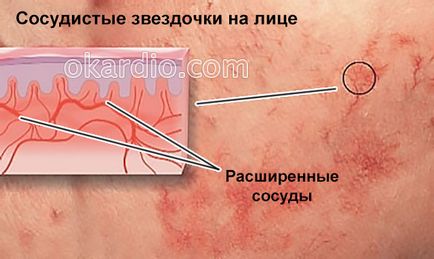 Cum sa scapi de asteriscuri vasculare