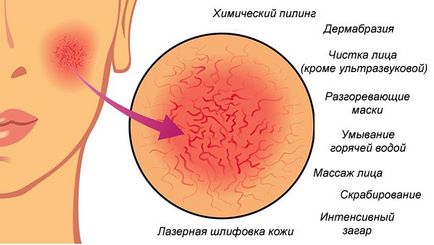 Cum sa scapi de asteriscuri vasculare