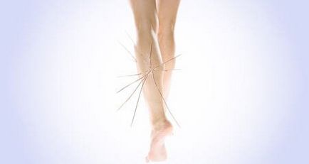 Cum sa scapi de asteriscuri vasculare Cum sa scapi de asteriscuri vasculare