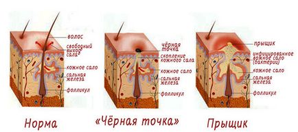 Acnee pe fata la domiciliu