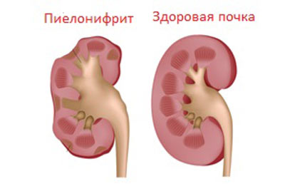 inflamație a rinichilor la un copil simptome, semne și tratamentul adolescenților