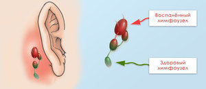 Tratamentul de inflamare a ganglionilor limfatici din spatele urechii