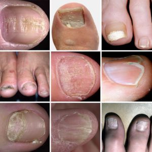 Ce se poate face cu unghiile de la picioare