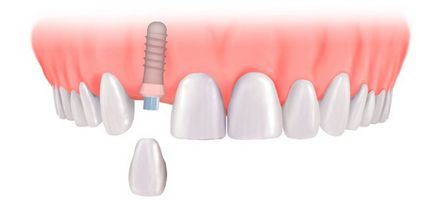dinți Inplontanty ce este
