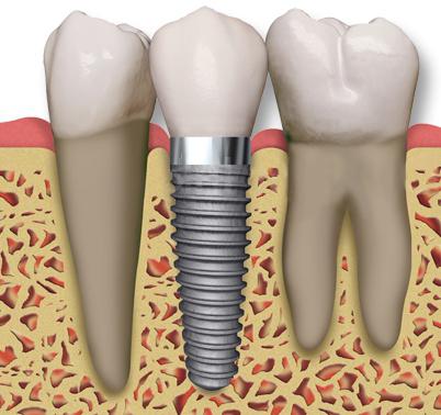 dinți Inplontanty ce este