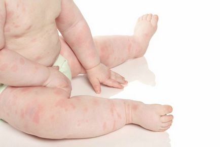 Dermatita atopica la sugari decât pentru a trata seboreica, dermatita atopica si scutec