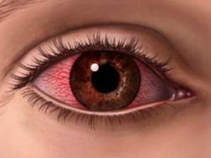 Alergia la ochi - modul de a trata pleoape de la produsele cosmetice