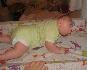 fat anencefalie cauze, diagnostic, fotografii pacient (anencefalie) fat anencefalie cauze, diagnostic, fotografii pacient