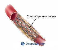 nave angioplastia (artere coronare), extremitatile inferioare, carotida