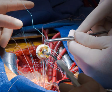 angioplastie vasculară și balon arteriale, cu laser și coronariană
