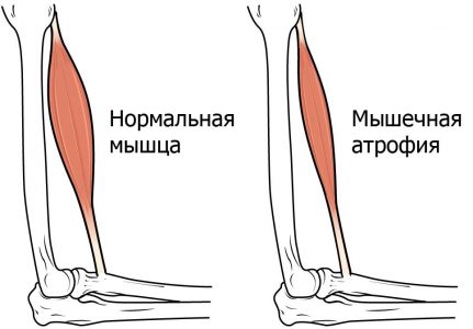 Simptome atrofie musculara si tratament, cum de a recupera