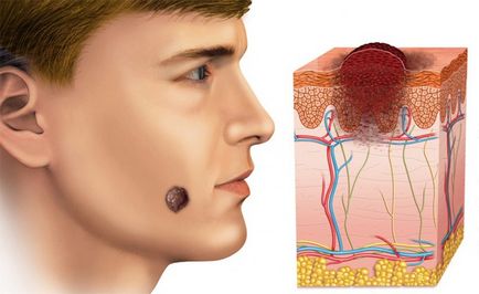 Bazala carcinomul cu celule de piele simptome, tratament și îndepărtarea remedii populare