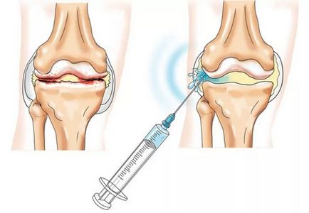 Blocada a genunchiului, care este astfel de comentarii, și prețul medicamentelor