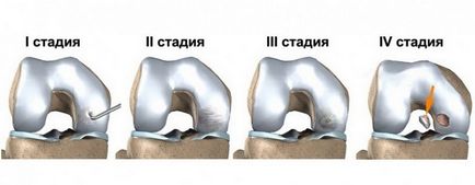 Koenig genunchi tratamentul bolilor articulare, cauze, simptome