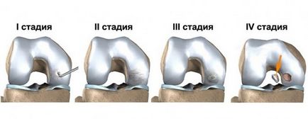 Cauzele bolii Koenig, simptome, diagnostic și tratament