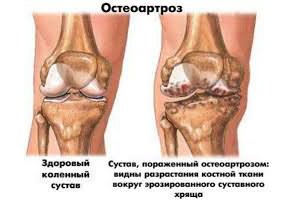 Boala este numit ca articulațiile picioarelor