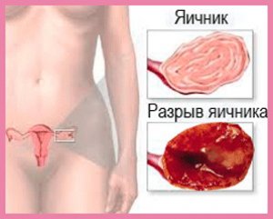 ovar Sore stânga la femei, de ce trage, dureri sau colita stânga ovar și ce să facă