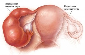 ovar Sore stânga la femei, de ce trage, dureri sau colita stânga ovar și ce să facă (doare) ovar Sore stânga la femei, de ce trage, dureri sau colita stânga ovar și ce să facă