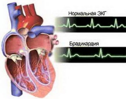 Bradicardia - cauze, simptome, simptome și tratament