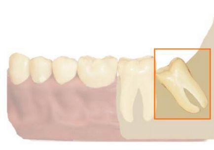 Ce să faci când dinții cad cauze de pierdere a dintilor - medicamente pentru tratamentul și prevenirea