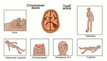 Ce să faci când contuzie la domiciliu, primul ajutor, dureri de cap