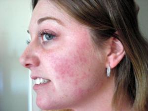 Că este un acarian de piele cauze ale unei persoane, simptomele de acarianul subcutanat facial și tratament