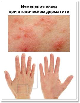 Ce este dermatita atopica si cum de a vindeca simptomele și tratament, nutriție, film