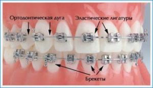 Ce este un suport pe dinti cum de a pune, cât de mult sunt acolade înainte și după instalare