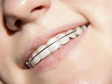 Ckoby pe dinti - indicații și contraindicații pentru instalare
