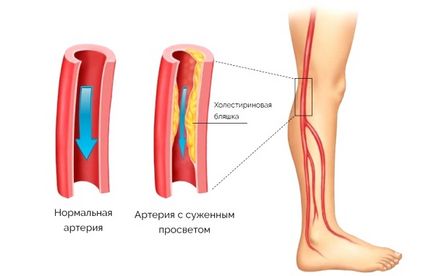 Simptomele neuropatiei diabetice, tratament, remedii populare