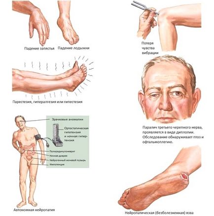 Simptomele neuropatiei diabetice, tratament, remedii populare