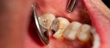 Ce arsenic în dinte - acțiunea și utilizarea arsenicului