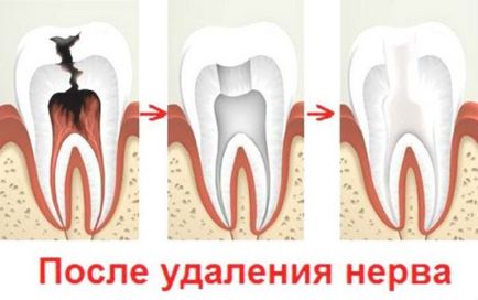 Ce arsenic în dinte - acțiunea și utilizarea arsenicului