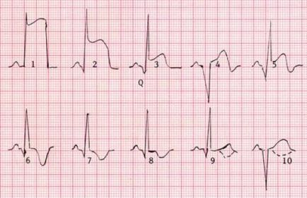 ECG infarct miocardic descifrare semne, localizare
