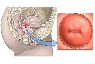 ectopic de col uterin