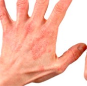 Eczeme pe degete - cauze, tratament