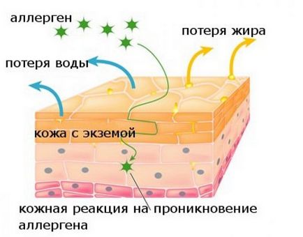 Eczema pe degete unguent disgidroticheskaya tratament între uscat