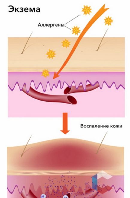 Eczema pe degete unguent disgidroticheskaya tratament între uscat