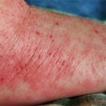 Eczeme pe degete - disgidroticheskoy tratament unguent, remedii populare, uscate
