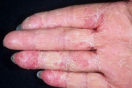 Eczema degetelor tipuri principale de dermatoze, în special simptome și tratament