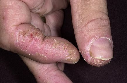 Eczema degetelor cauze si tratamente