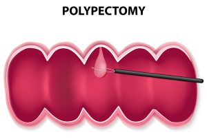 polip endoscopic polipectomie uterin, de stomac, intestin, esofag, dieta nas