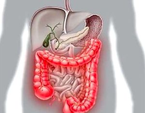 Enterocolita - simptome și tratament de remedii populare