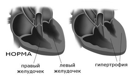Eos (axa electrică a inimii) și deviația poziției